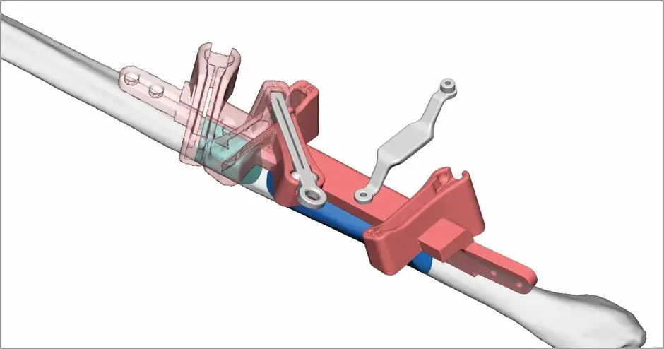 VSP - Virtual Surgical Planning