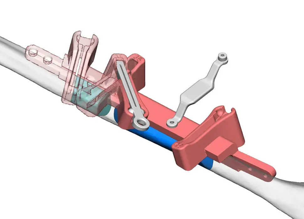 Fibula guide on fibula