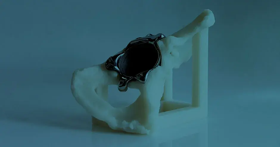 3D 프링팅 금속 소재의 의료용 모델