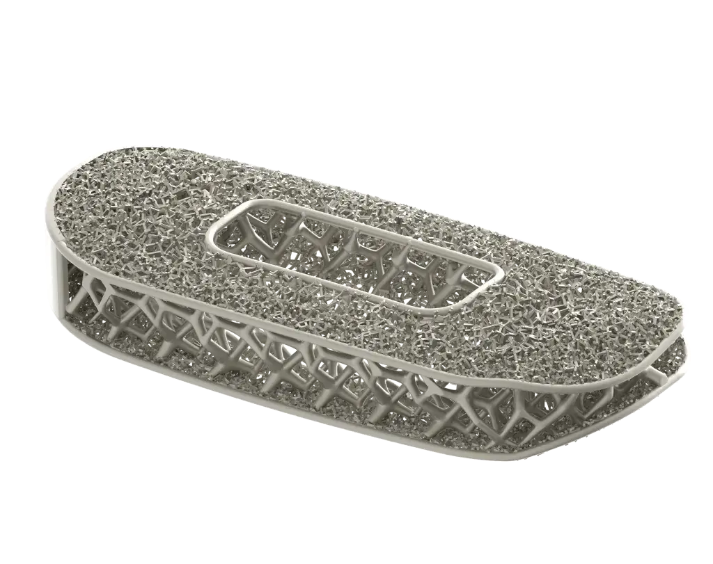 3D 프린팅을 사용하여 생산된 NuVasive의 최적화된 척추 임플란트