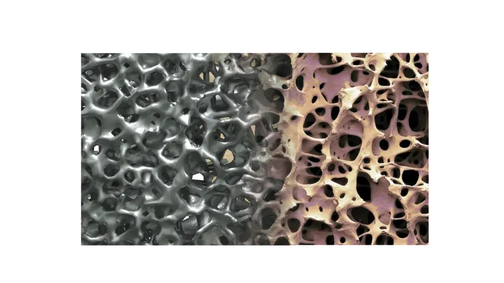 NuVasive의 척추 임플란트 Modulus 제품군의 Design은 척추 임플란트 환자의 임상 결과를 개선하도록 설계되었습니다.