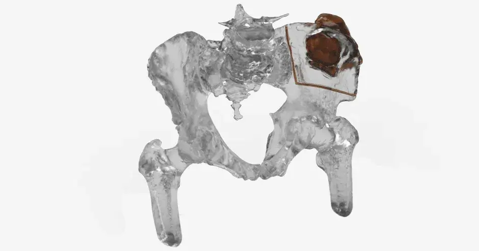 VSP Orthopaedics anatomic model for orthopaedic oncology