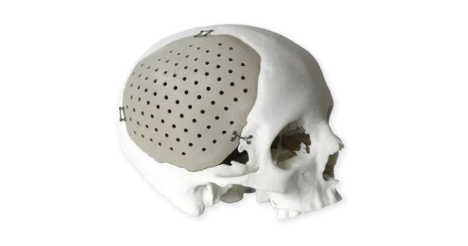 PEEK 뇌 임플란트