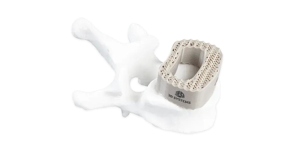 3D 프린팅 척추 케이지 PEEK