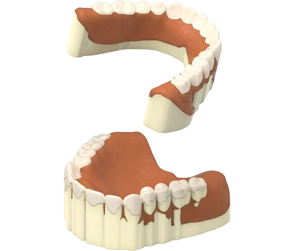 NextDent 프로덕션 제거 지원