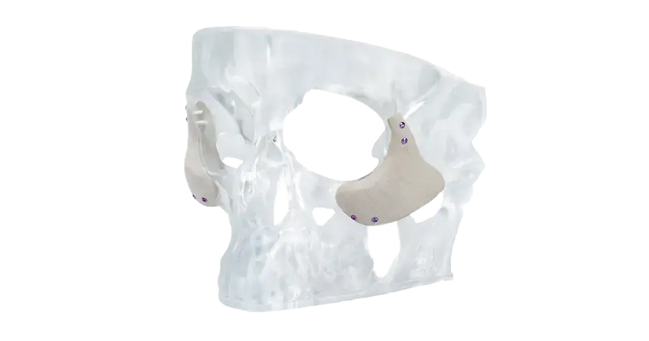 두개골 임플란트