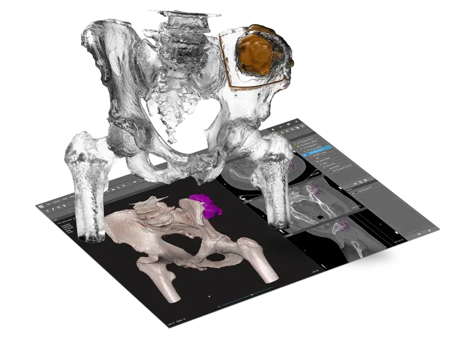 D2P software and anatomic model demonstrating tumor resection solution