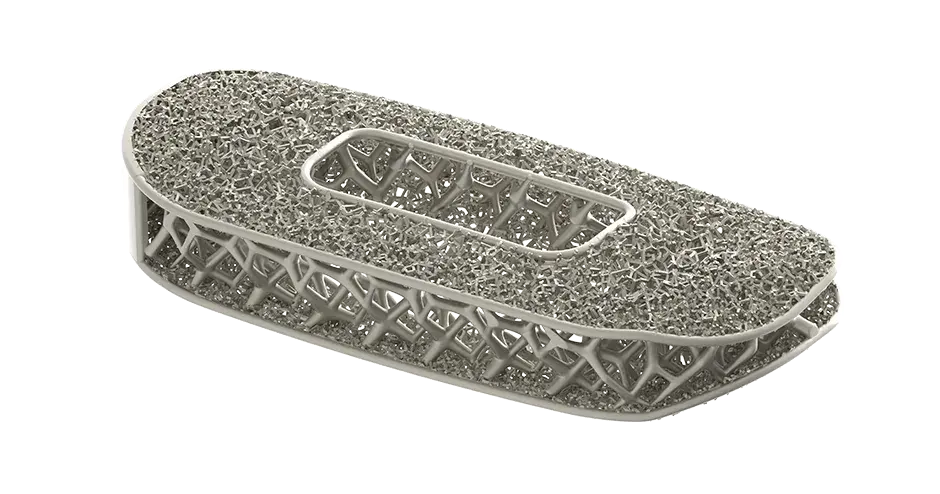 3D 프린팅을 사용하여 생산된 NuVasive의 최적화된 척추 임플란트 